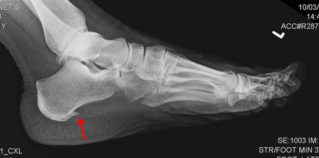 Radiografia de paciente com esporões no pé