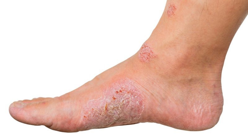 Fotografia de pé diabético com sintomas na pele